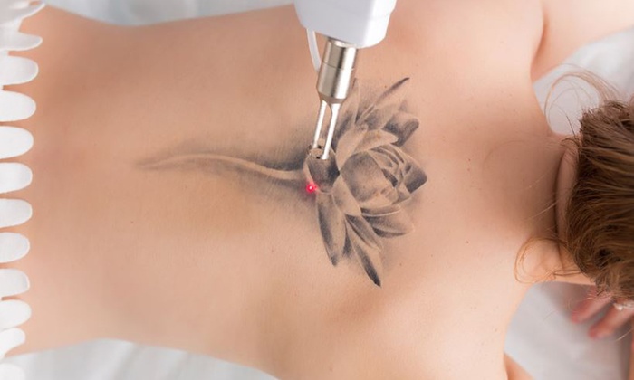 Laser Tattoo Removal and Its Endless Benefits